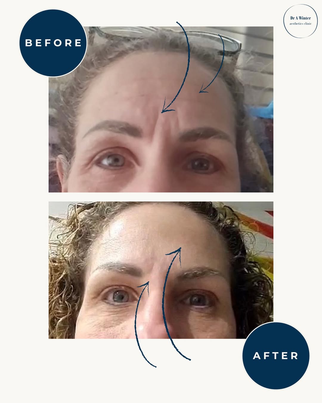 Before and after frown line treatment example