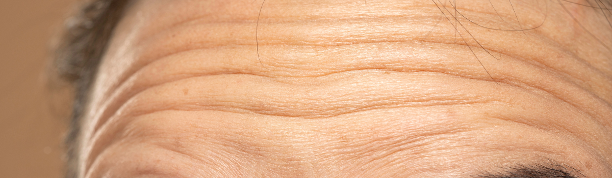 Close-up of forehead lines, a common concern discussed during anti-wrinkle consultation